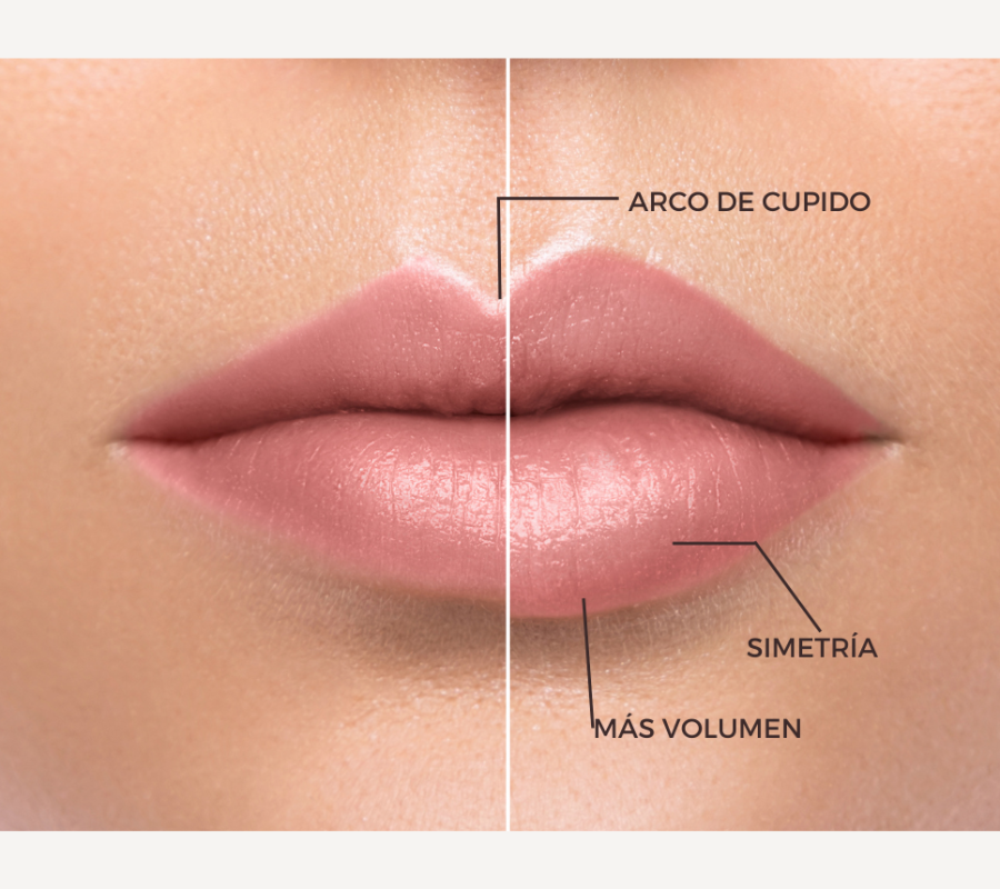 queiloplastia queiloplastia